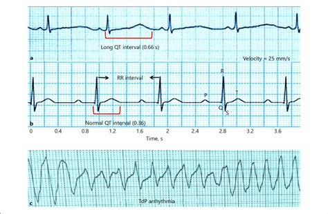 a An ECG trace of lead II with long QT interval (66 ms). b A normal ...