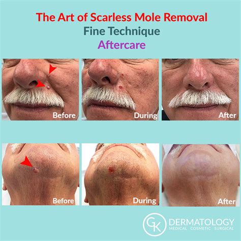 Scarless Mole Removal - GK Dermatology, PC