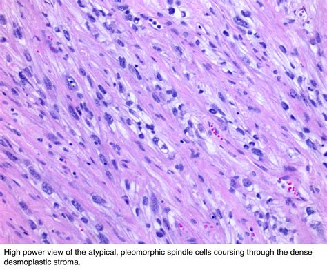 Pathology Outlines - Sarcomatoid