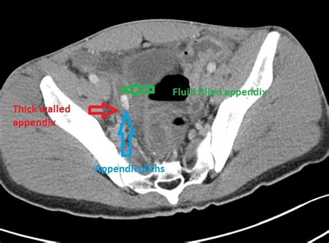 Appendicitis Ct Radiopaedia It is a very common condition in general radiology practice and is ...