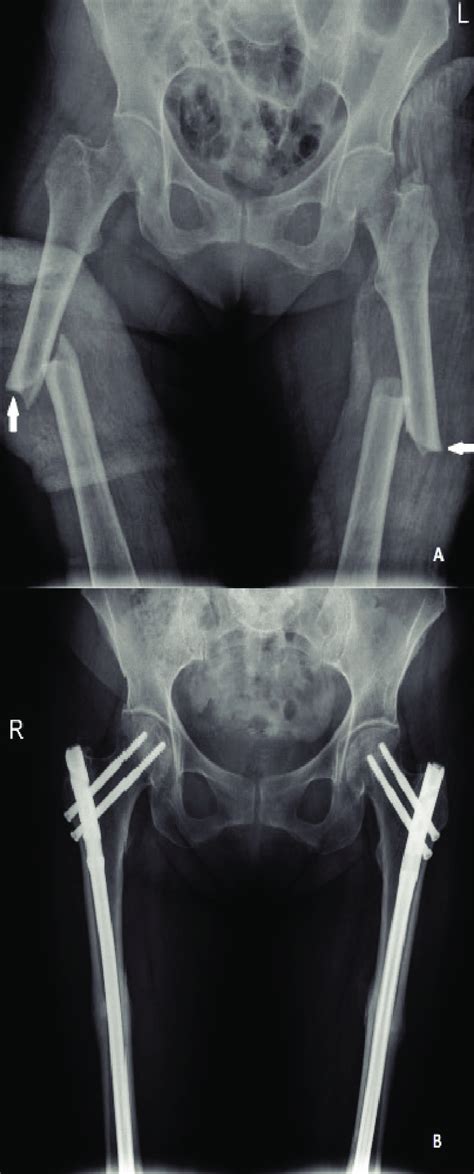 Bilateral atypical femur fracture (AO/OTA 32A3) A. Preoperative... | Download Scientific Diagram