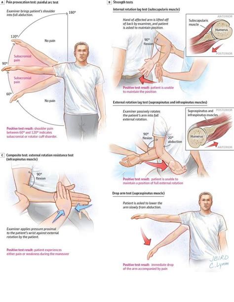 Rotator cuff management series (1/5) – proactivephysioknowledge