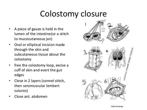 Diverting Colostomy Surgery