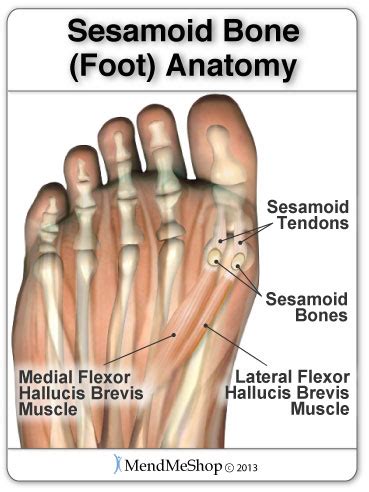 Sesamoiditis