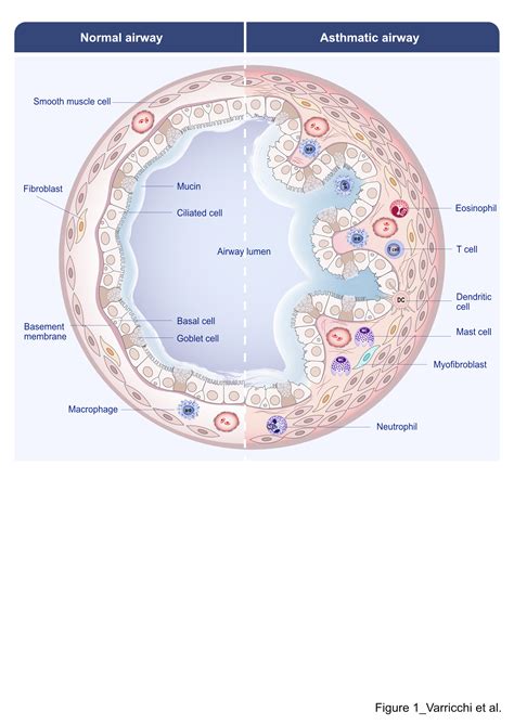 Biologics and Airway Remodeling in Severe Asthma - Authorea