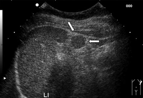 Sonography of the Spleen - Benter - 2011 - Journal of Ultrasound in Medicine - Wiley Online Library