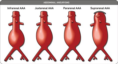 Vascular surgery - Wikiwand