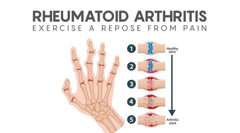 Can You Exercise With Rheumatoid Arthritis - Exercise Poster