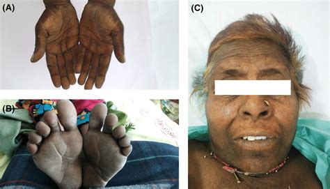 (A) Tripe palms with palmer hyperpigmentation, (B) skin changes in... | Download Scientific Diagram