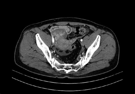 Computed tomography images before the first debulking surgery ...