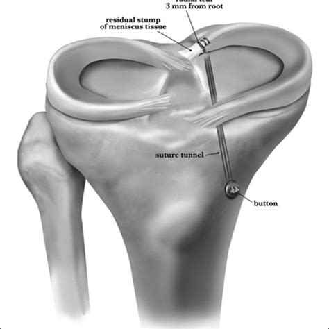 —anatomy of posterior roots. Mte: medial tibial eminence; lte: lateral... | Download Scientific ...