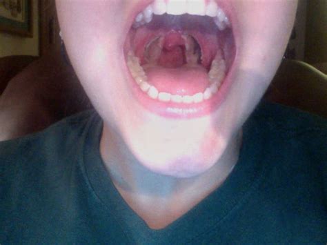 Tonsillectomy Scabs -Pictures