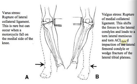 Varus Vs Valgus Fracture