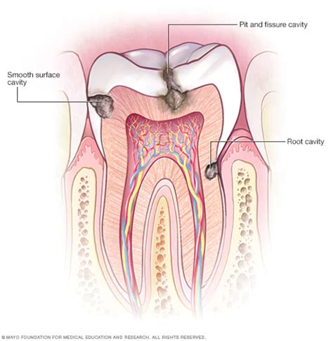 What Causes a Cavity? - Nicollet Station Dental