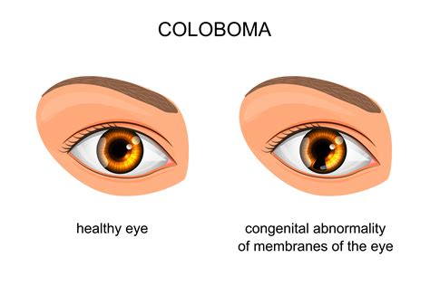 Coloboma: Types, Symptoms, and Associated Conditions