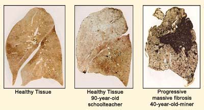 Pneumoconiosis| Interactive Health