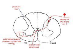 Tract of Lissauer- lateral spinothalamic tract, responsible for pain ...