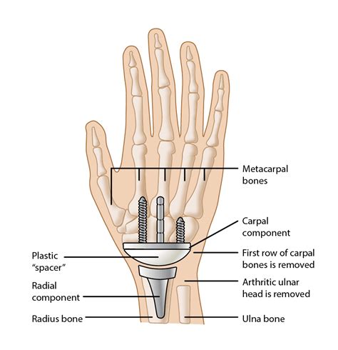 Wrist Joint Replacement (Wrist Arthroplasty) - OrthoInfo - AAOS