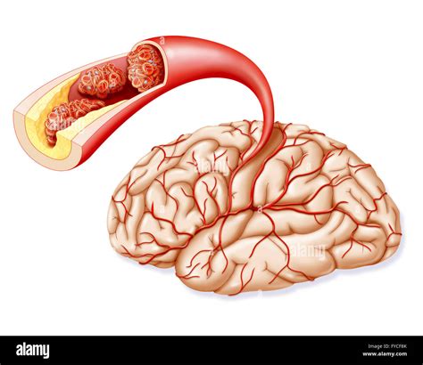 CEREBROVASCULAR ACCIDENT Stock Photo - Alamy