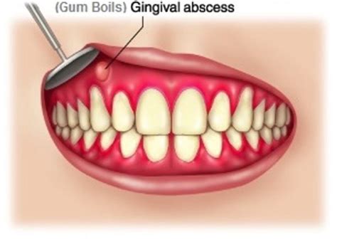 Bump on the gums: causes and treatment of symptoms - Medical Information