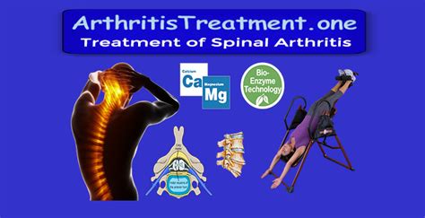 Arthritis of the Spine - Arthritis Treatment