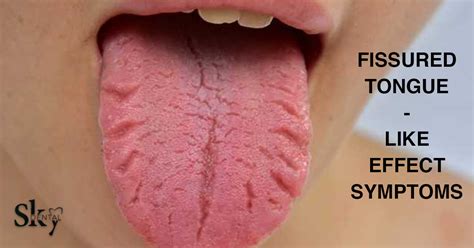 Fissured Tongue Symptoms - Sky dental care hospital