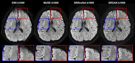 Figure 4. Detailed comparison among DWI, MUSE, SRResNet, and SRGAN reconstructed images.