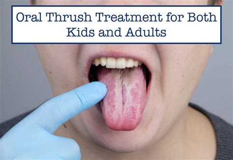 Oral Thrush Treatment for Both Kids and Adults