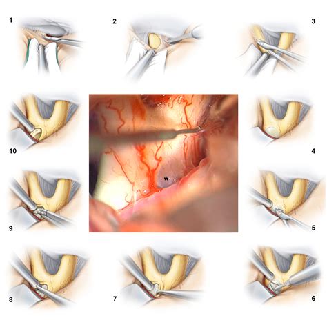 Subfrontal Translamina Terminalis Approach | The Neurosurgical Atlas