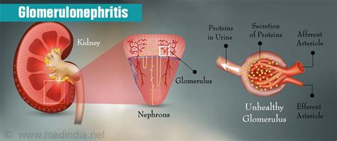 Dialysis - Hemodialysis, Peritoneal Dialysis and Role of Diet and Drugs