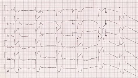 Inferior STEMI • LITFL • ECG Library Diagnosis