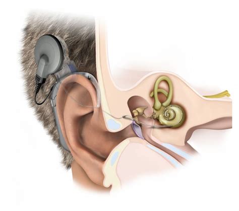 Hearing Institute Atlantic — Beyond Traditional Hearing Aids: Cochlear ...