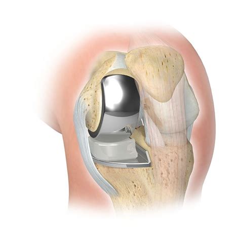 Zimmer Biomet - Knee Replacement | Knee replacement, Knee replacement ...