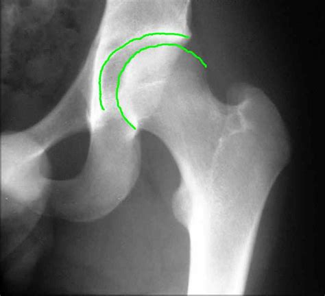 Patient X-Ray Images Bonita Springs, FL | Psoas Muscle Release Bonita Springs, FL | Surface Hippy