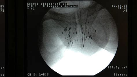 Brachytherapy for prostate cancer: What to expect