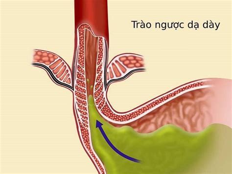 Learn about the Schatzki ring of the esophagus | Vinmec