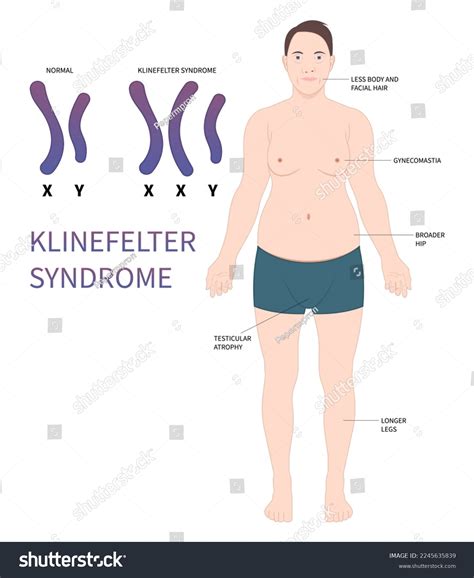 Klinefelter Syndrome: All You Need To Know – Sdlgbtn, 56% OFF