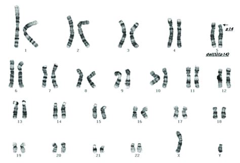 Deletion Karyotype