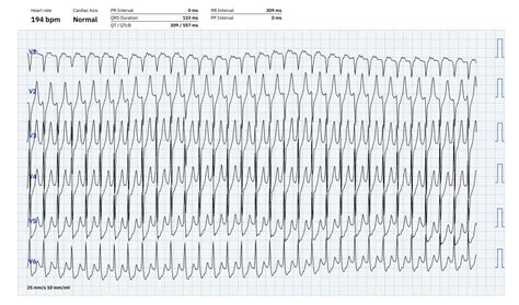 AVNRT TYPICAL FORM | ECG Guru - Instructor Resources