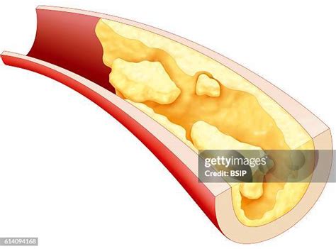 Thrombus Formation Photos and Premium High Res Pictures - Getty Images