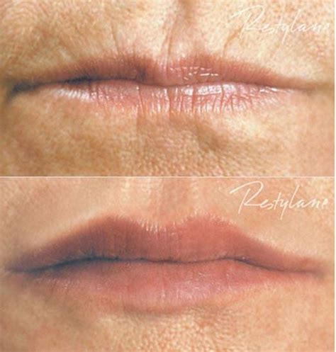 Lip Fillers & Lip Enhancement | SkinViva Manchester