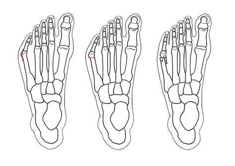 Tailor's Bunion Surgery- A Complete Guide | Foot & Ankle