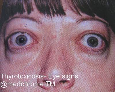 Thyrotoxic Crisis or Thyroid Storm : Management | MEDCHROME