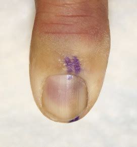 Nail matrix biopsy of longitudinal melanonychia: Diagnostic algorithm including the matrix shave ...