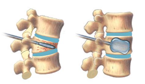 Kyphoplasty - Spines Dorset