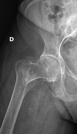 Femoral neck fracture - basicervical | Radiology Case | Radiopaedia.org