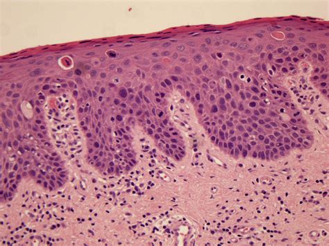 Oral potentially malignant disorders - Diagnostic Histopathology