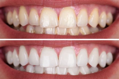 Teeth Whitening in Troutman, Statesville, Lake Norman and Iredell County