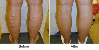 Endovenus Abalation: Laser Vein Treatment for Varicose Veins | Midwest Vein Care in St. Louis