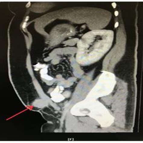 Change in operating time for unilateral inguinal hernia repair in 93... | Download Scientific ...